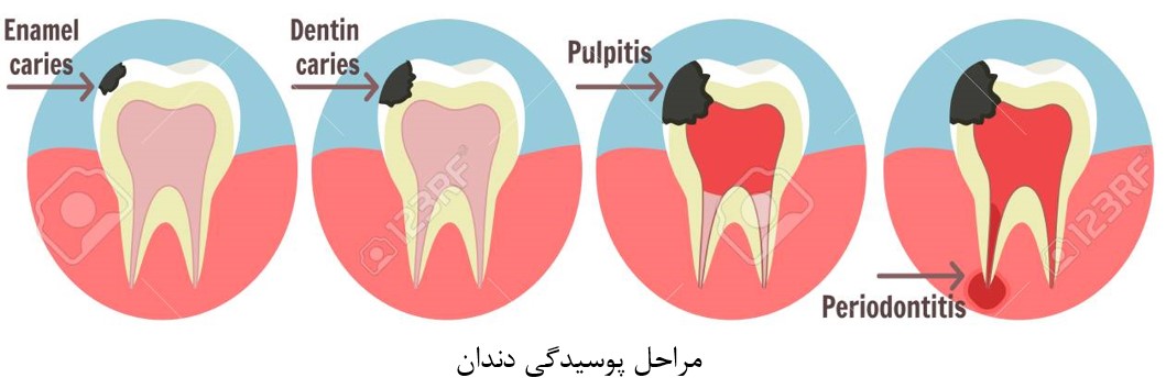 پالپیت دندان چیست؟