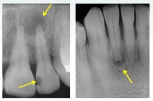 معاینه ریشه دندان (تست پالپ دندان)