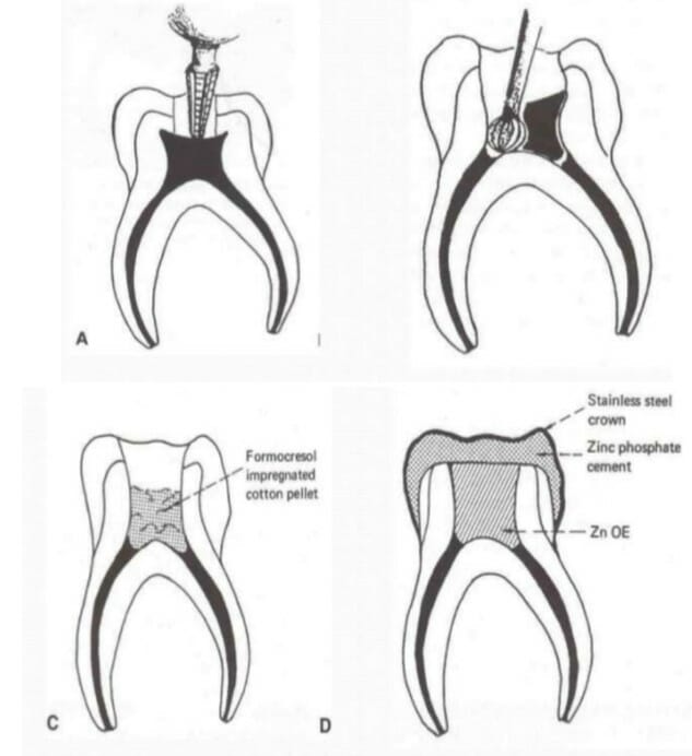 انواع روش های درمان ریشه دندان (عصب کشی)