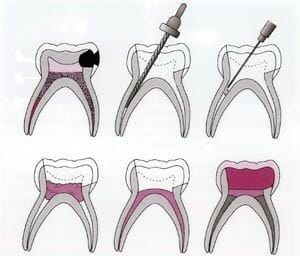 انواع روش های درمان ریشه دندان (عصب کشی)