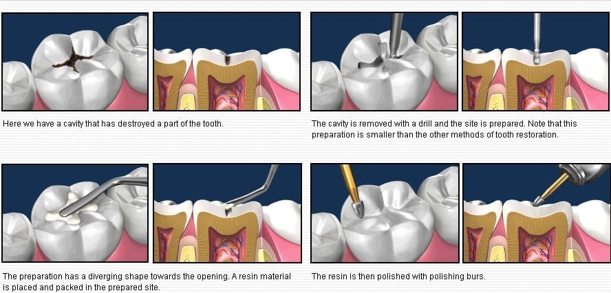 تفاوت پر کردن و عصب کشی دندان