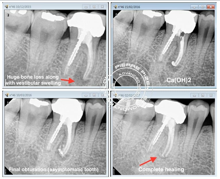 عصب کشی مجدد ریشه دندان