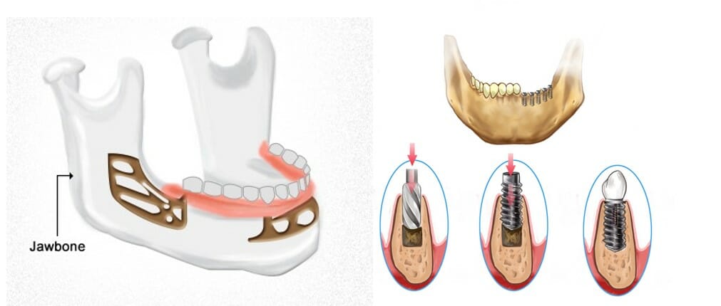 انواع ایمپلنت های دندانی