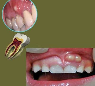 تشخیص و درمان آبسه دندان