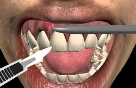 تشخیص و درمان آبسه دندان