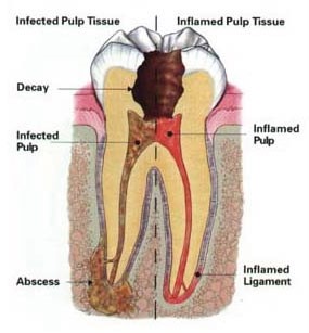 علل مرگ دندان یا عصب دندان