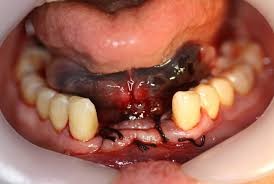 مراقبت های پس از جراحی کاشت ایمپلنت های دندانی