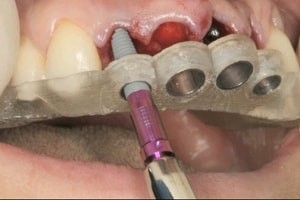مشکلات پس از کاشت ایمپلنت های دندانی