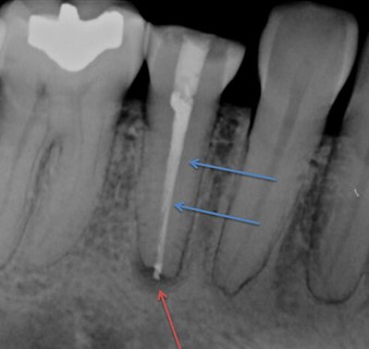 علل مرگ دندان یا عصب دندان