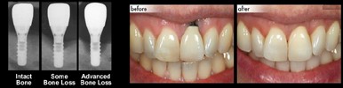 مشکلات پس از کاشت ایمپلنت های دندانی - بخش دوم