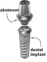 اجزاء ایمپلنت های دندانی