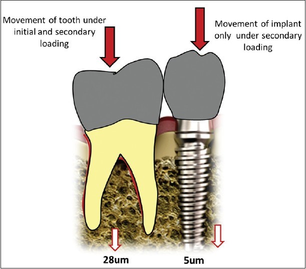 مشکلات پس از کاشت ایمپلنت های دندانی - بخش دوم