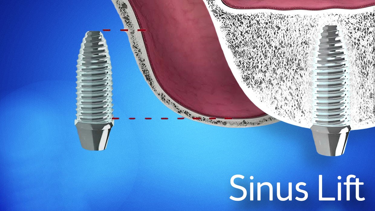 Синус лифтинг в стоматологии фото