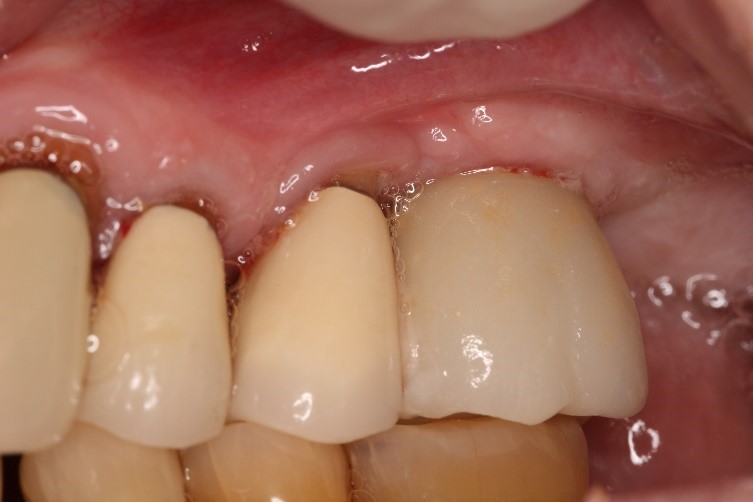  شکست کاشت ایمپلنت دندانی