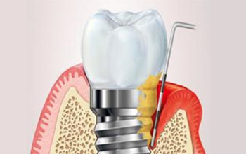 شکست کاشت ایمپلنت دندانی