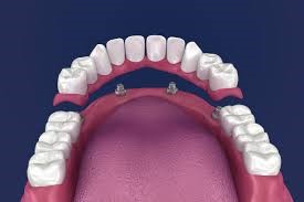 مقایسه ایمپلنت دندانی فوری با ایمپلنت سنتی