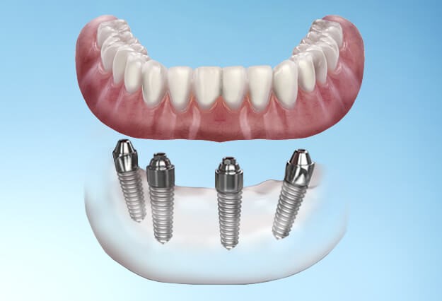 مقایسه ایمپلنت دندانی فوری با ایمپلنت سنتی