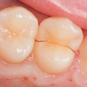 شکستگی و خارج شدن دندان از حفره