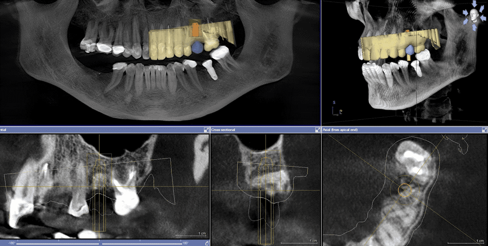رادیوگرافی با اشعه ایکس دندانپزشکی