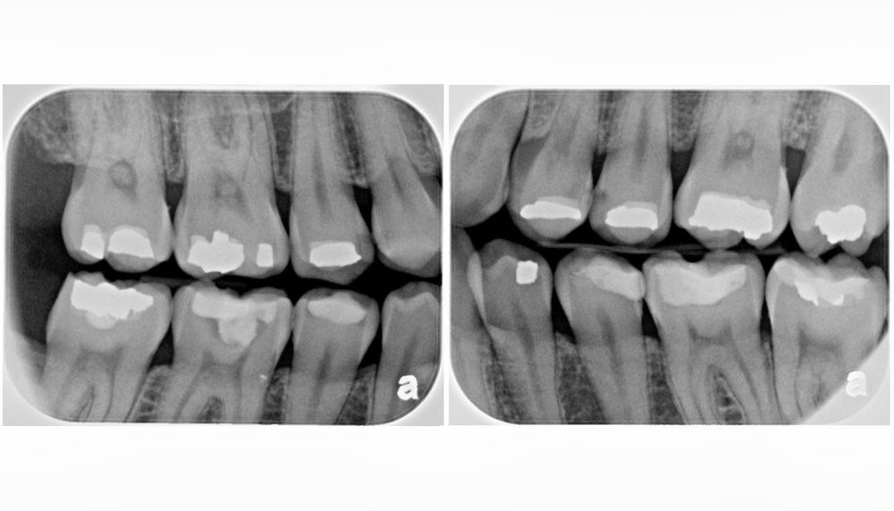 رادیوگرافی با اشعه ایکس دندانپزشکی