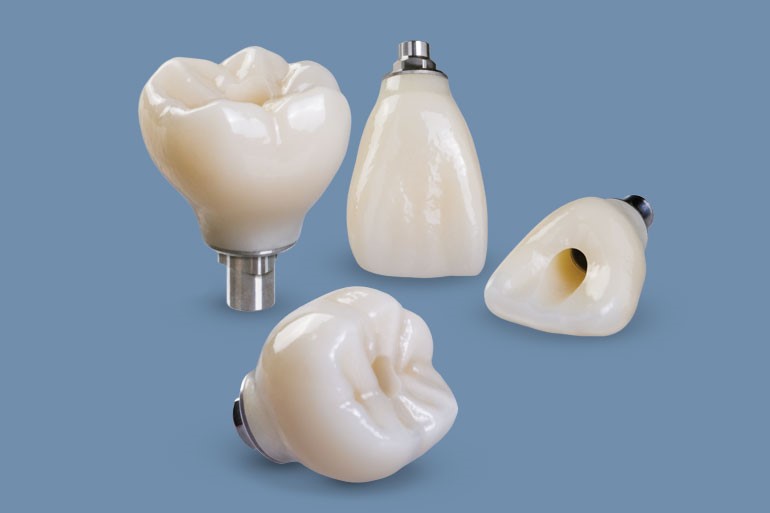 اتصال روکش به ایمپلنت دندان