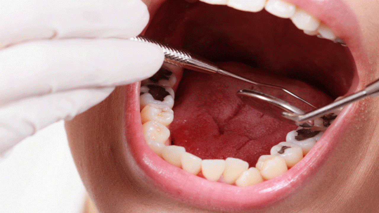 آمالگام های دندانی 