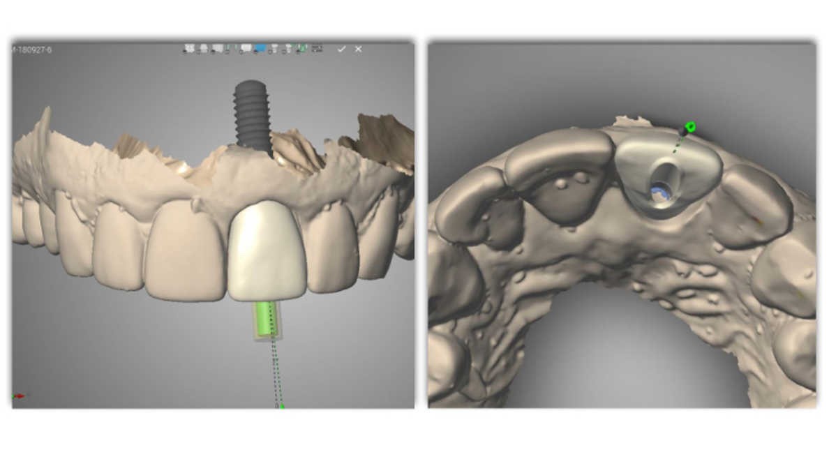 فناوری دیجیتال در کاشت ایمپلنت دندانی