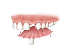  پروتزهای مصنوعی و ایمپلنت های دندانی