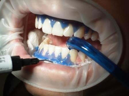بلیچینگ یا سفید کردن دندان ها