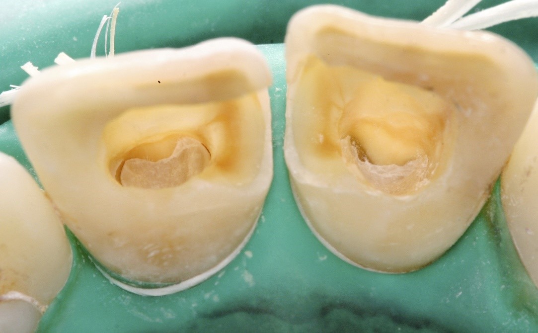بلیچینگ یا سفید کردن داخلی دندان