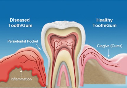 ایمپلنت دندانی با بیماری لثه