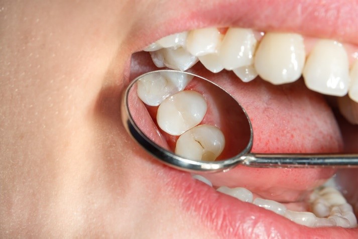 حسایت دندان پس از پر کردن