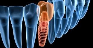 باورهای نادرست ایمپلنت دندانی