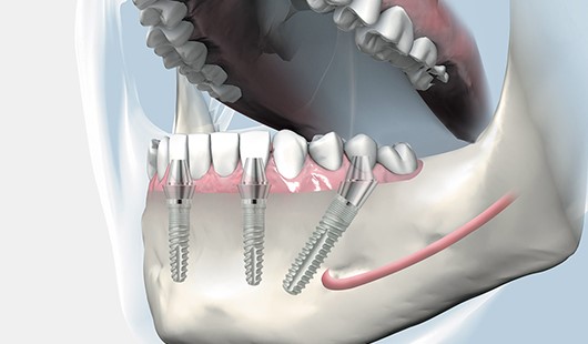 باورهای نادرست ایمپلنت دندانی