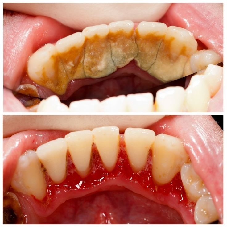 جرمگیری دندان درد دارد؟
