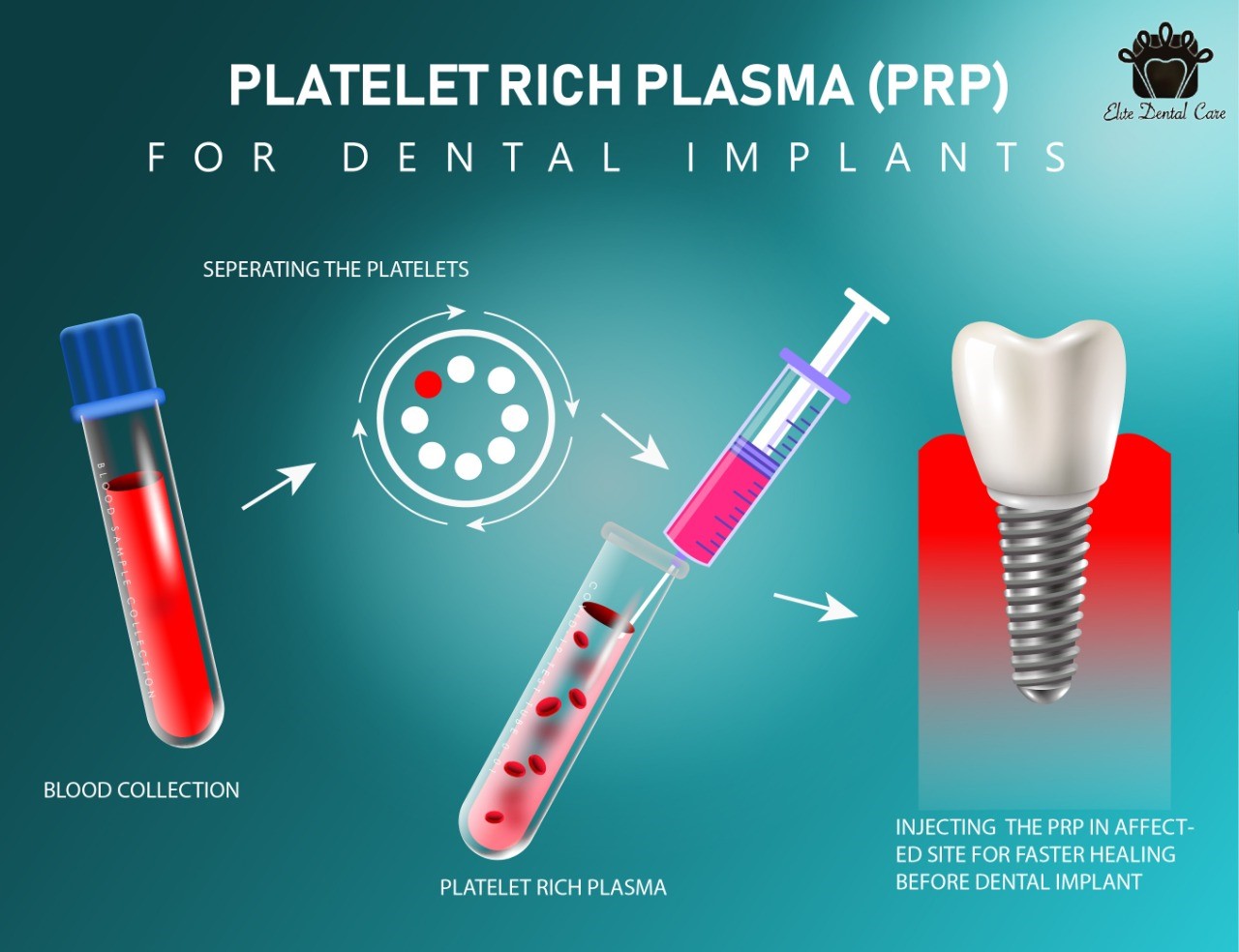 کاربرد PRP در جراحی دهان و دندان