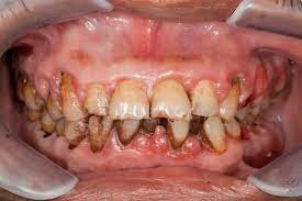 تأثیر سیگار بر دندان و دهان