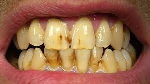 تأثیر سیگار بر دندان و دهان