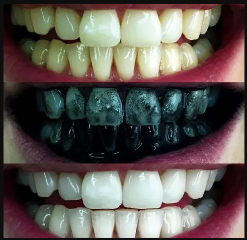  سفيد كردن دندان با زغال فعال