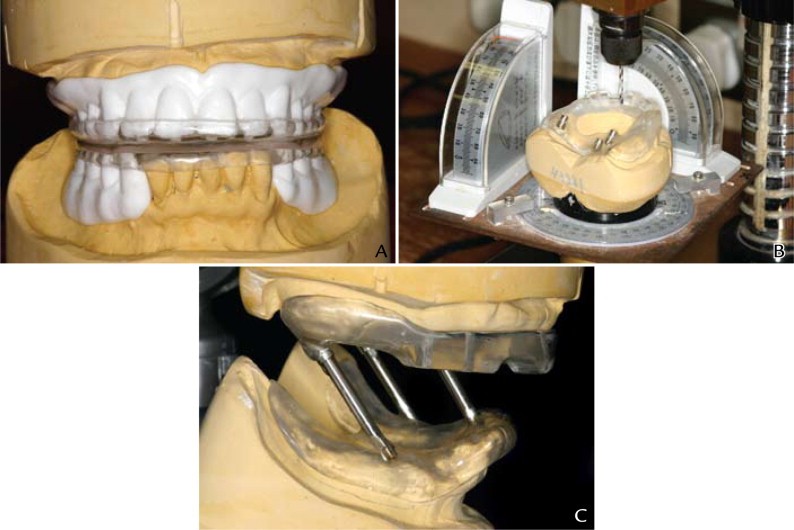 کاربرد راهنمای جراحی در کاشت ایمپلنت های دندانی