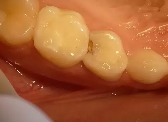 پوسیدگی بین دندانی