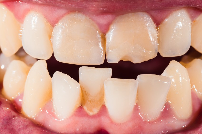 علت و درمان دندان کج