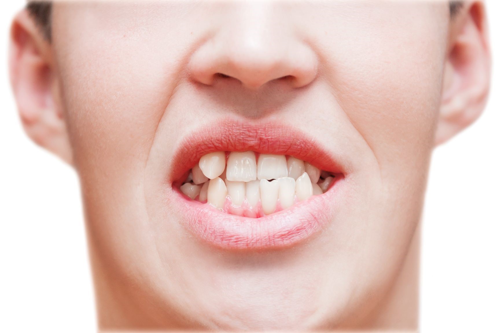 علت و درمان دندان کج