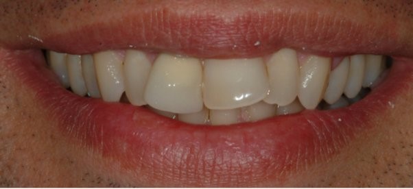 علتهای جابجا شدن دندان