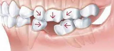علتهای جابجا شدن دندان