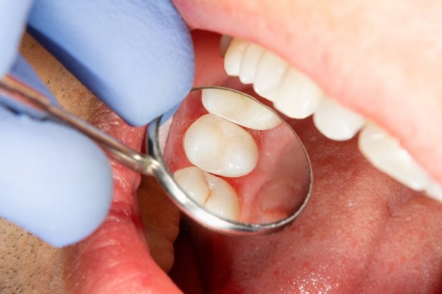 مراقبت بعد از عصبکشی دندان