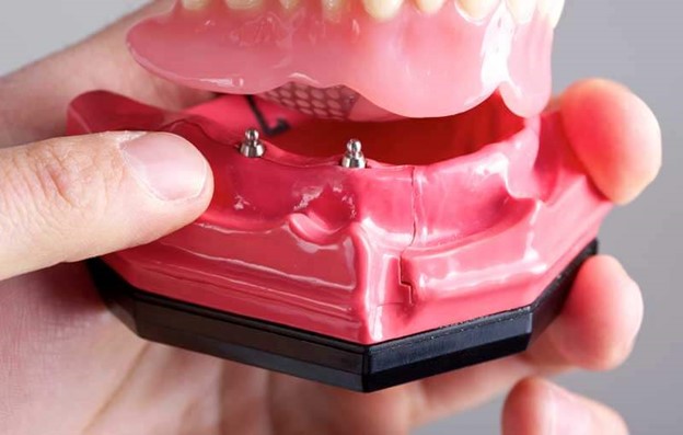 مینی ایمپلنت دندانی