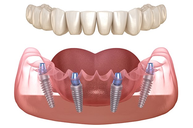 ایمپلنت دندانی All- On- 4