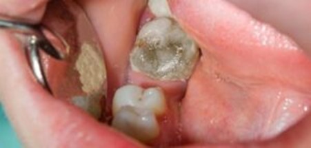خطرات عدم درمان دندان عفونی
