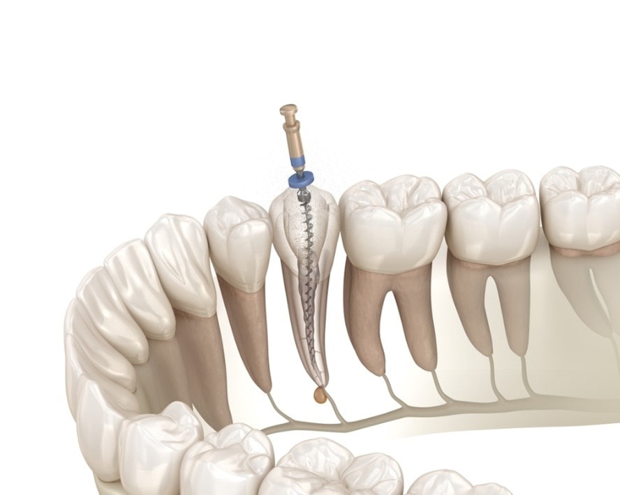 درمان ریشه روی کدام دندان ها راحت تر است